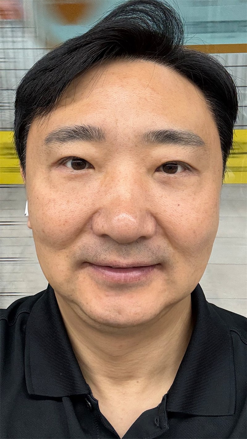 Lower Eyelid